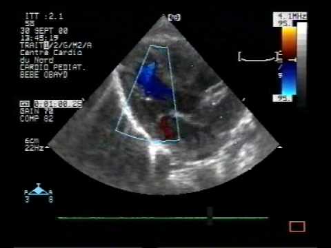  Transposition der großen Arterien, ventrikulärer Septumdefekt, atrialer Septumdefekt, Patent Ductus Arteriosus (2/2)