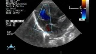 preview picture of video 'echocardiogram:transposition of the great arteries2/2 vsd asd pda'