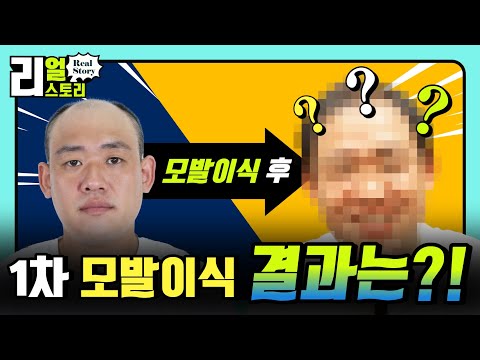 [리얼스토리] 대머리 개그맨 '이원구'의 모발이식 후기 1편 (kor/eng/日語/中文)