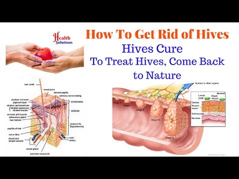 How To Get Rid of Hives - Hives Cure - To Treat Hives, Come Back to Nature Video