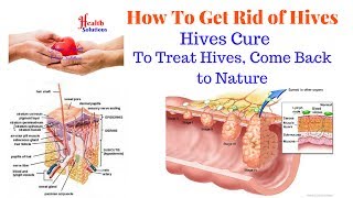 How To Get Rid of Hives - Hives Cure - To Treat Hives, Come Back to Nature