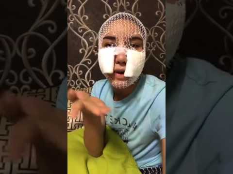 Safiey Ilias after plastic surgery removing implant