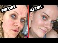 HOW I CURED MY #ROSACEA