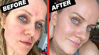 HOW I CURED MY #ROSACEA