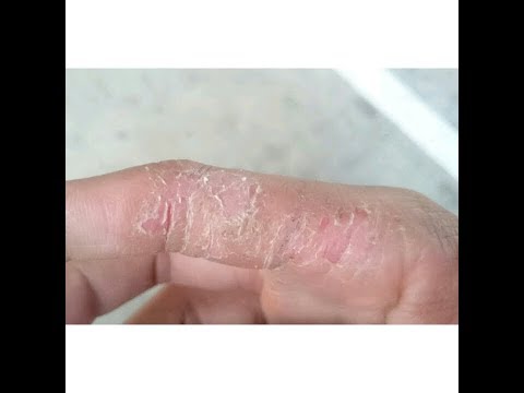ครีมจาก neurodermatitis ด้านหลัง กลากในสวีเดน