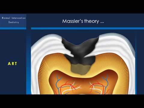 Minimal Intervention Dentistry 