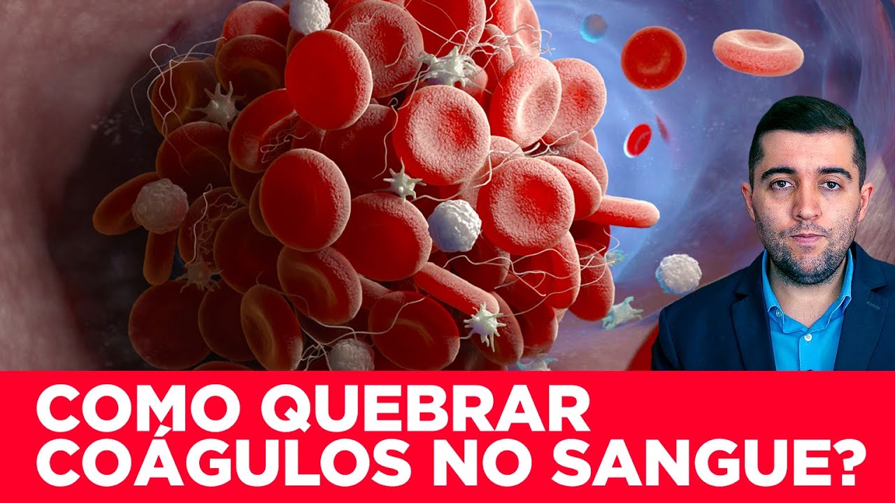 Veias entupidas e coágulos nas artérias: como desobstruir rápido a circulação, remédio ou cirurgia?