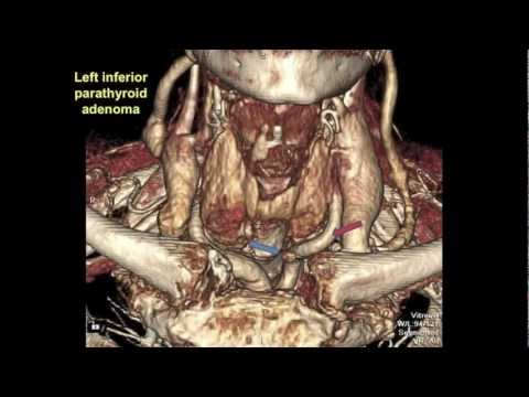 Endoscopic Transaxillary Parathyroidectomy