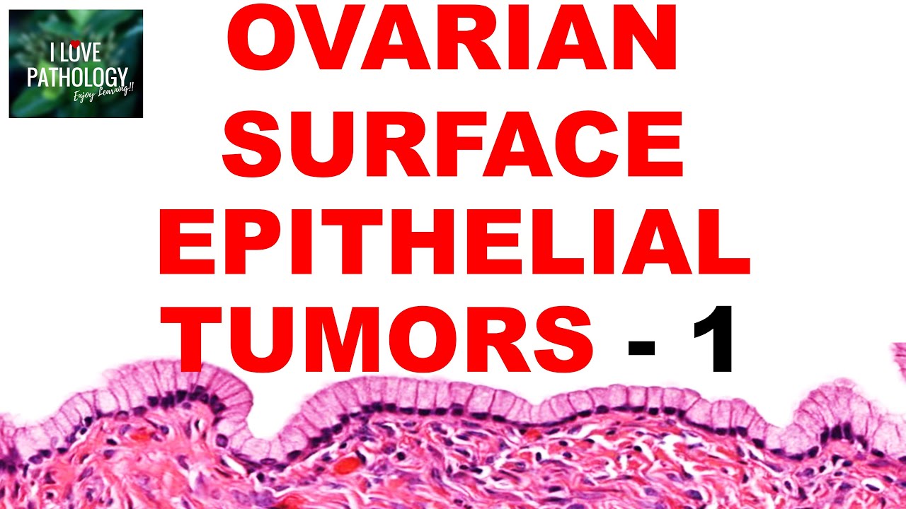 OVARIAN TUMORS -  Part 2 : SEROUS AND MUCINOUS TUMORS- Etiopathogenesis and morphology