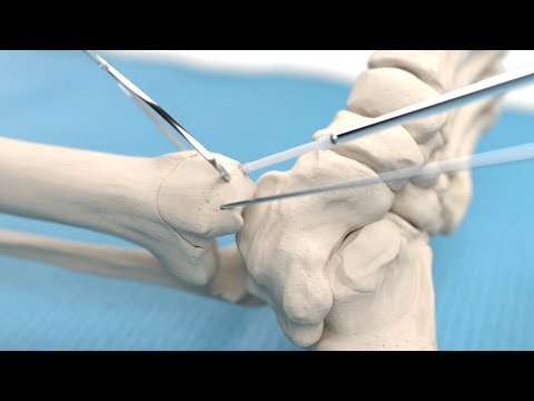 Medial malleolar osteotomy and talar osteochondral fragment fixation using Inion CompressOn™ screw