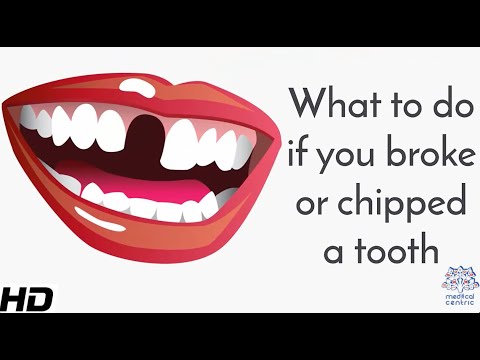What To Do If You Broke Or Chipped A Tooth?