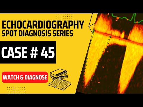 Echo Case 45: Echocardiography Spot Diagnosis Series - Echo for Beginners - Cardiology TOACS
