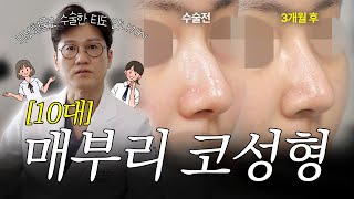 10대 환자의 무보형물 코성형 3개월 케이스리뷰! 매부리, 복코 개선으로 자연스러운 라인 완성 (자가 비중격 + 근막)