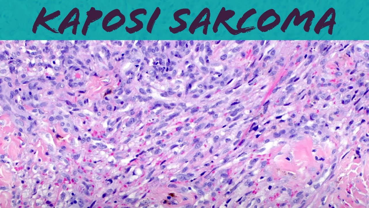 Kaposi sarcoma (vascular tumor pathology histology dermpath dermatology dermatopathology HIV AIDS)