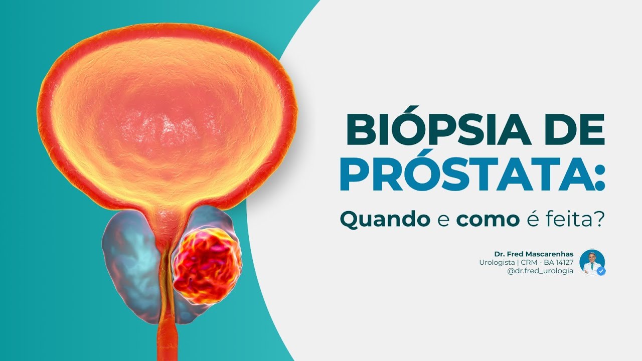 Biópsia de Próstata: Quando e como é feita?