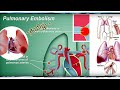 Pulmonary Embolism தமிழ் Deep Vein Thrombosis DVT MEDITAMIL
