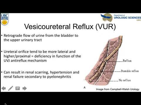 Vesicoureteral Reflux: An Update