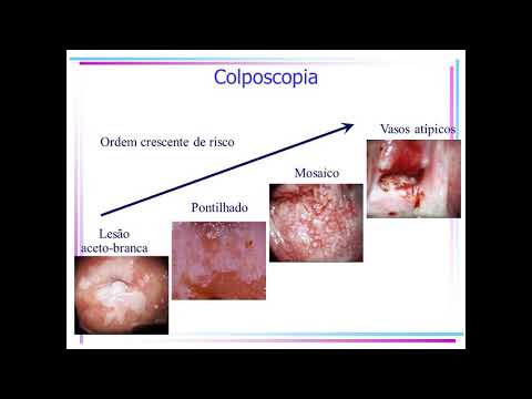 Human papillomavirus infection and pregnancy