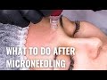 Microneedling Aftercare Do S And Don Ts For Best Results
