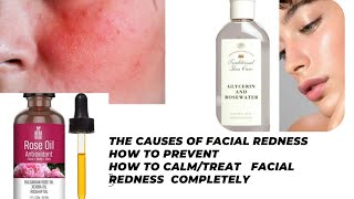 How To Treat, Prevent And Calm Facial Redness