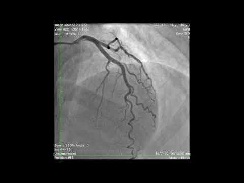 Spontaneous Coronary Artery Dissection-(SCAD) - The Heart Attack You Never See Coming