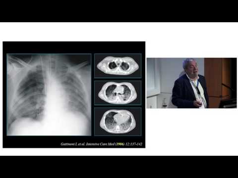 ARDS Professor Luciano Gattinoni