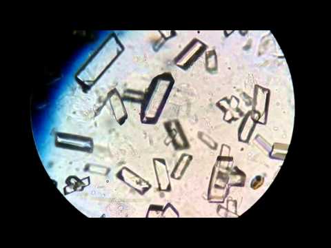 Cristales de fosfato triple en sedimento urinario