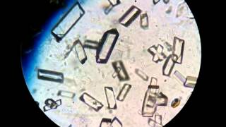 Cristales de fosfato triple en sedimento urinario