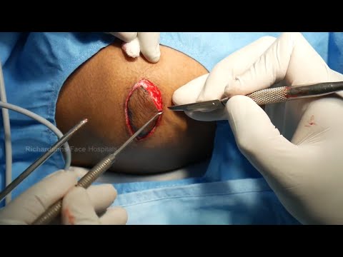 Video On The Keloid Scar Removal Surgery
