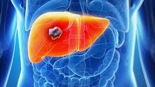 tumours of liver DR SAMEH GHAZY