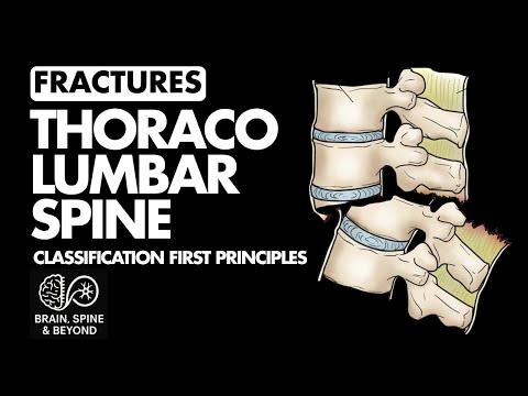 Thoracolumbar Spinal Fractures Classification Series (1/4) -  Historical Aspect, Spinal Instability