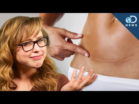 Mag-ehersisyo upang alisin cellulite Paano sa mawala timbang nang walang pagsusuri