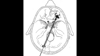 The Wound That Killed Lincoln video