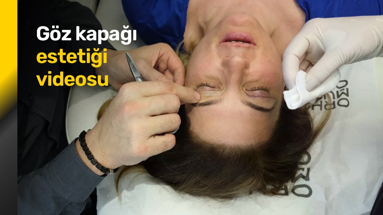 Göz estetiği ameliyatı videosu - Op. Dr. Orhan Murat Özdemir