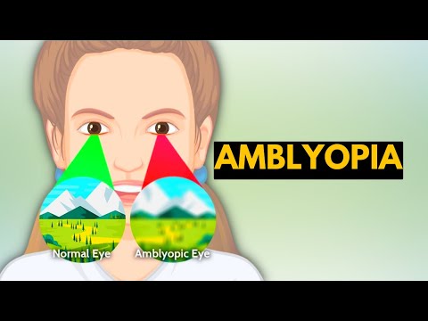 hogyan lehet javítani a látás amblyopia-t
