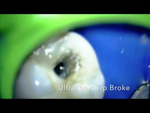 Broken File Removal - Remoción de lima separada