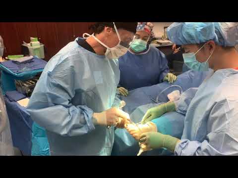 Cosmetic Toe Shortening Long Toe Surgery Video Without Metal Pins
