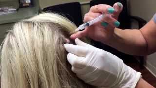 Removing a cerebriform nevus (a benign mole) from the scalp. For medical education- NSFE.
