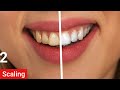 Dental Treatments Using Latest Equipments WP Dental Centre