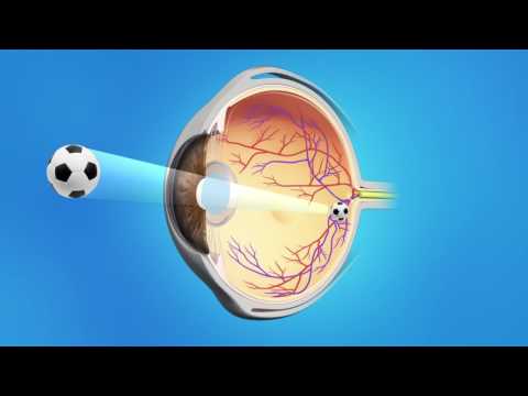 download lagu mp3 mp4 Phaco Surgery Cost, download lagu Phaco Surgery Cost gratis, unduh video klip Phaco Surgery Cost