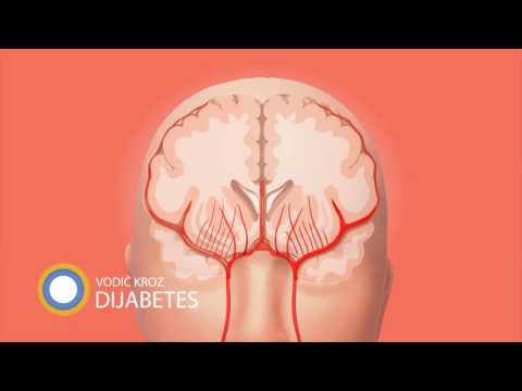 Ko poslednjih godina najčešće dobija moždani udar i kakav je odnos mladih osoba u odnosu na starije