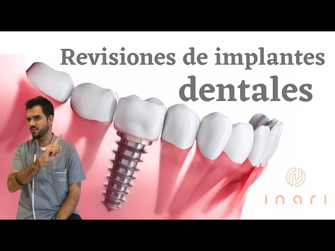 Revisiones de implantes dentales
