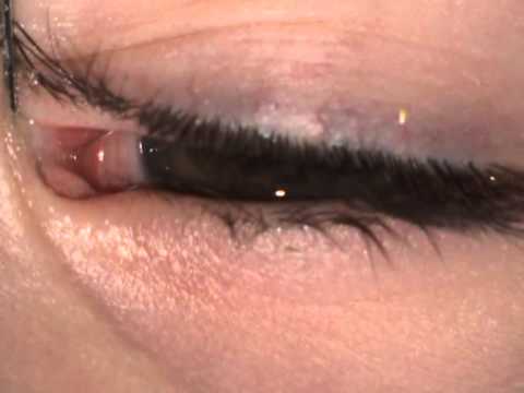 Il massager per il ringiovanimento di laser di persona di Rio de Janeiro laserlift di video Lo stringimento per la persona di crema