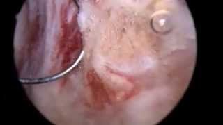 preview picture of video 'Résection endoscopique adénome prostate /  Reims'