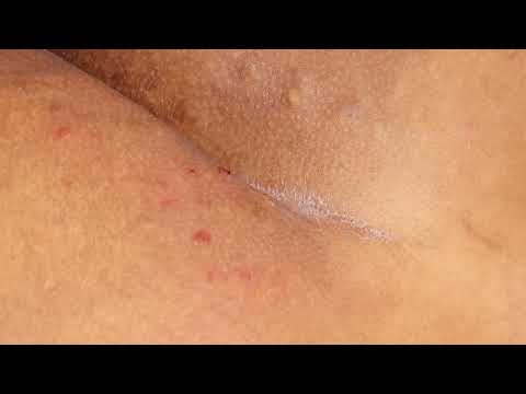 I myself have never seen steatocystomas on this area