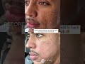 Shorts THE BUILDING PROCESS ACNE SCAR COMBO FOR SENSITIVE SKIN TYPES Dr Jason Emer