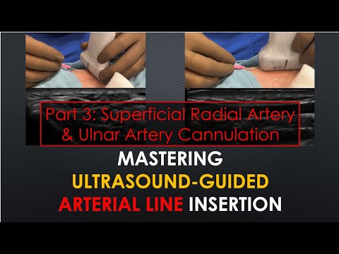 Mastering Ultrasound-Guided Arterial Lines [Pt 3/3: Superficial Radial | Calcified | Ulnar Artery]