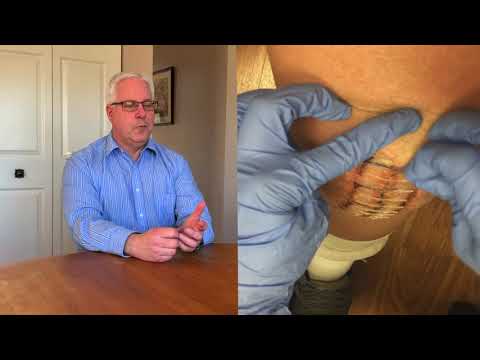 John Szalinski - Zip Removal Experience