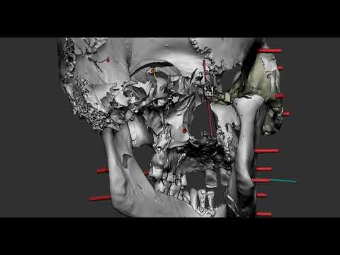 3D Facial Reconstruction