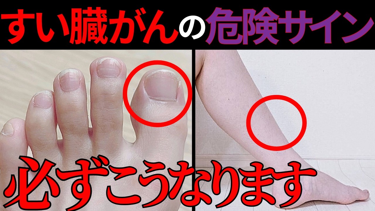 【医師監修】知らないと後悔する「すい臓がんの足の危険サイン」症状から予防法まで徹底解説